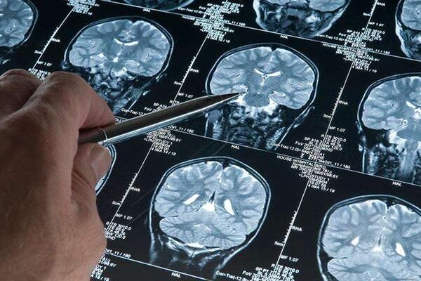 Erkeklerde gizli tehlike! Alzheimer araştırmalarında, demans riskini artıran genetik varyant bulundu: Bu varyanta sahip erkeklerde gelişme riski 2,39