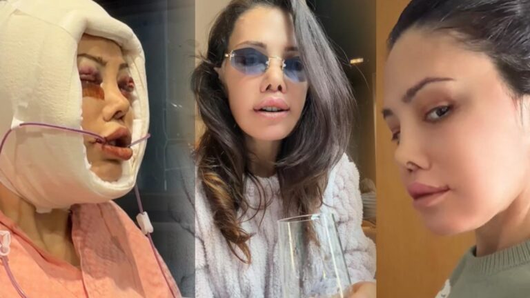 Yüz naklinin ardından revizyon ameliyatı olmuştu! Didem Ceran son haliyle korkuttu
